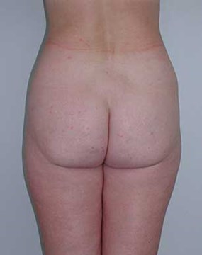 Body-contouring-4--pre.jpg