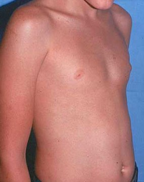 breast-15-male-po.jpg