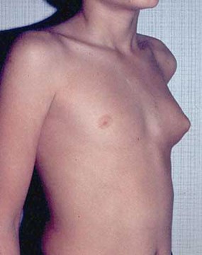 breast-15--male-pre.jpg