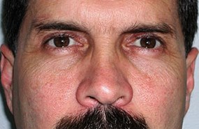 Brow-lift-after.jpg