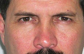 Brow-lift-before.jpg