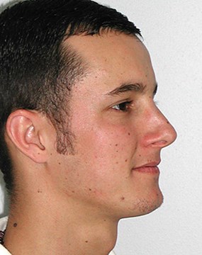 Case-11--rhinoplasty-post.jpg