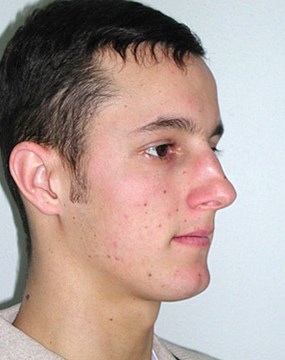 Case-11--rhinoplasty-pre.jpg
