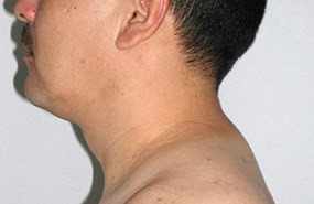Case-12-lipo-neck-post.jpg
