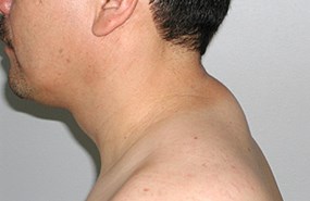 Case-12-lipo-neck-pre.jpg
