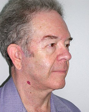 Case-13-Neck-lift-post.jpg