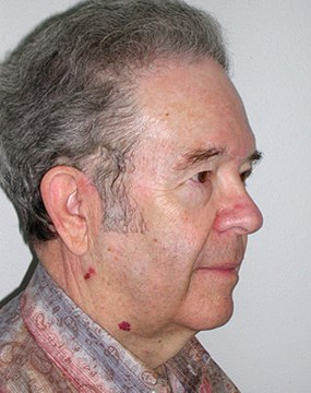 Case-13-Neck-lift-pre.jpg