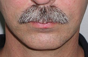 Chin-contouring-after.jpg