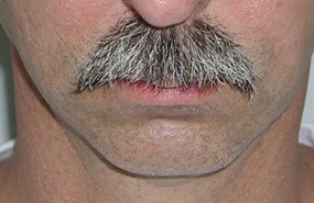 Chin-contouring-before.jpg