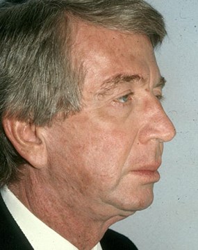 face-lift--after-oblique.jpg