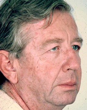 face-lift--before-oblique.jpg