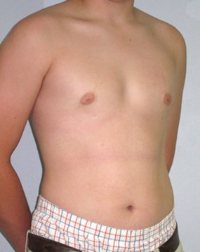 Gynecomastia-case3-after.jpg