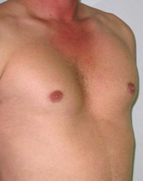 Gynecomastia-case-4-after.jpg