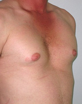 Gynecomastia-case-4-before.jpg