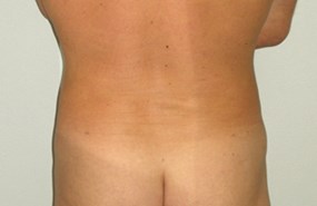 Liposculp-flanks-case4-aft.jpg
