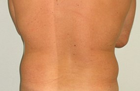 Liposculp-flanks-case4-bef.jpg