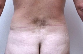 Liposculpture-of-flanks-aft.jpg