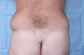 Liposculpture-of-flanks-bef.jpg
