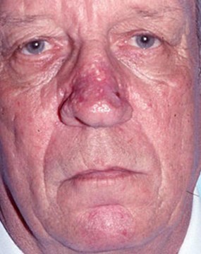 rhinophyma-after.jpg
