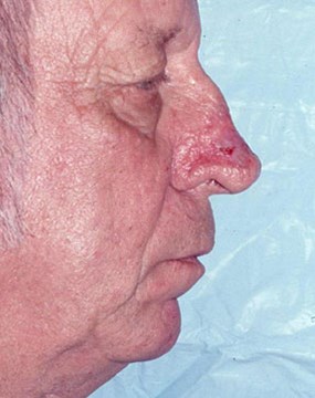 rhinophyma-side-after.jpg