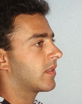 Rhinoplasty-2-after.jpg