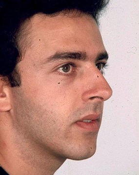 Rhinoplasty-2-before.jpg