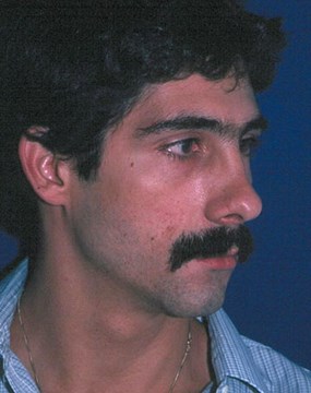 Rhinoplasty-3-after.jpg