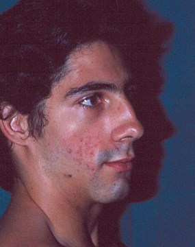 Rhinoplasty-3-before.jpg