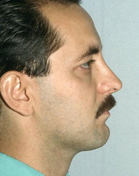 Rhinoplasty-after-side.jpg
