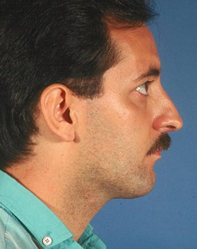 Rhinoplasty-before-side.jpg