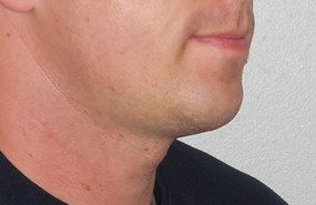 Case 2 chin contouring post.JPG