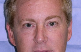 Case 4 Eyelid a.JPG