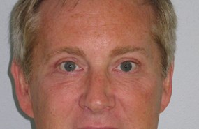 Case 4 Eyelid b.JPG
