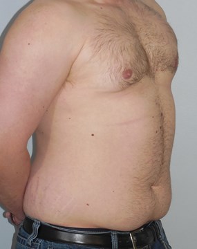 Case 5 Gynecomastia b.JPG