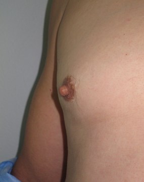 Case 6- Gynecomastia a.JPG