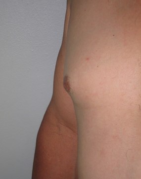 Case 6- Gynecomastia b.JPG