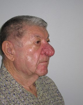 Case 6 Rhinophyma (fleshy nose) a.JPG