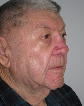 Case 6 Rhinophyma (fleshy nose) b.JPG