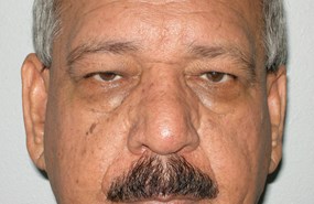 Case 7 Eyelid a.JPG