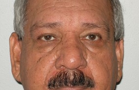 Case 7 Eyelid b.JPG