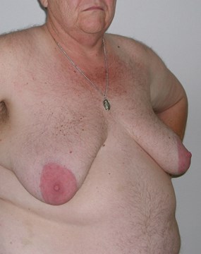 Case 7- Gynecomastia a.JPG