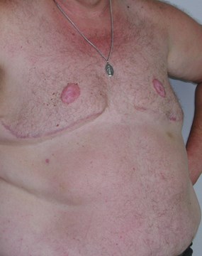 Case 7- Gynecomastia b.JPG