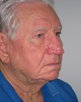 Case 7 Rhinophyma (fleshy nose) a.JPG