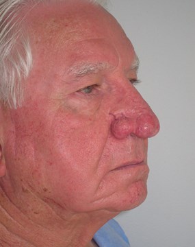 Case 7 Rhinophyma (fleshy nose) b.JPG
