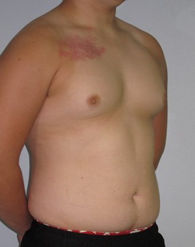 Case 9 Gynecomastia a.JPG