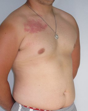 Case 9 Gynecomastia b.JPG
