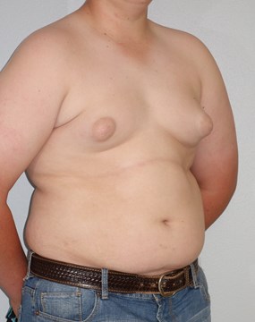 Case 10 Gynecomastia a.JPG