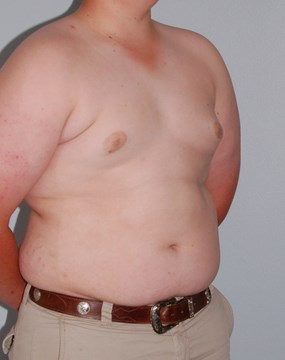 Case 10 Gynecomastia b.JPG